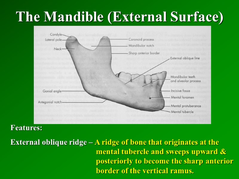 The Mandible (External Surface)   Features: External oblique ridge – A ridge of